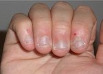 Nail biting can damage the growing part of the nail bed. Photo: en.,wikipedia.org